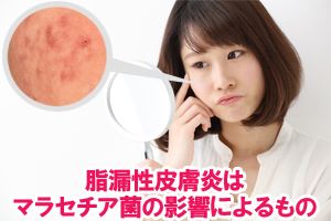 脂漏性皮膚炎はマラセチア菌の影響によるもの